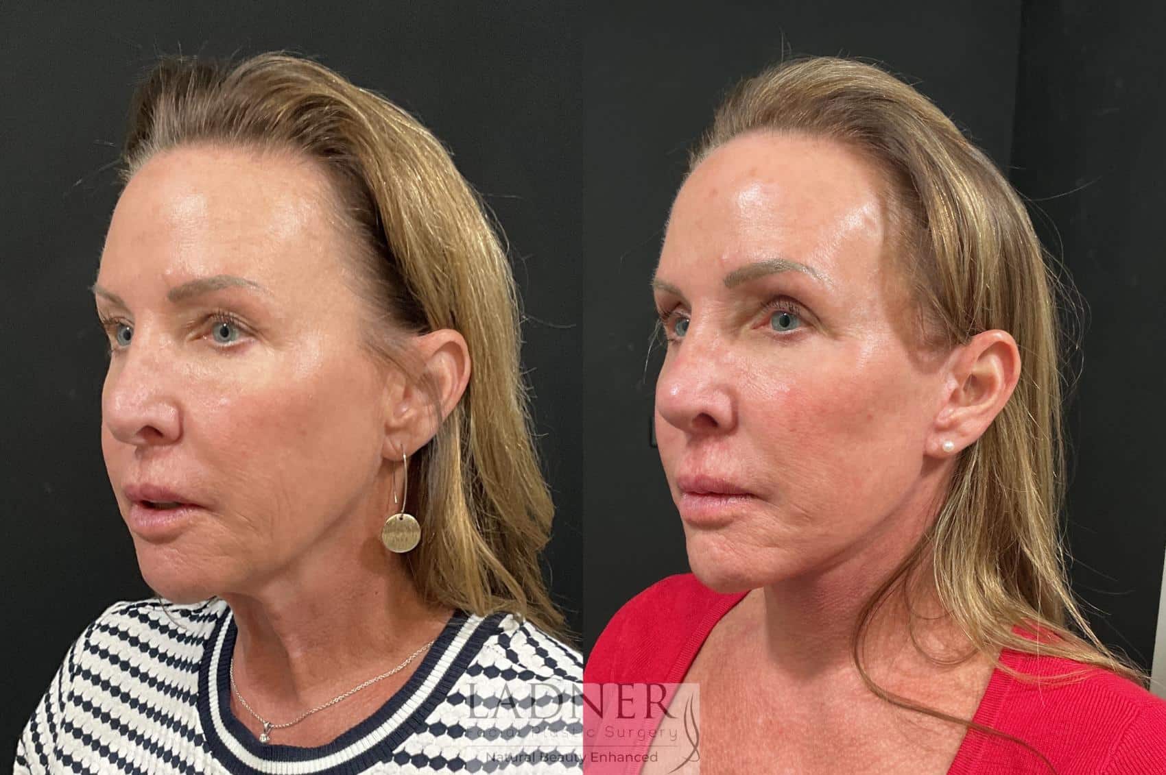 Before and After Image: Deep Plane Lower Facelift, Deep Plane Neck Lift, Fat Transfer to Cheeks - left-front-oblique