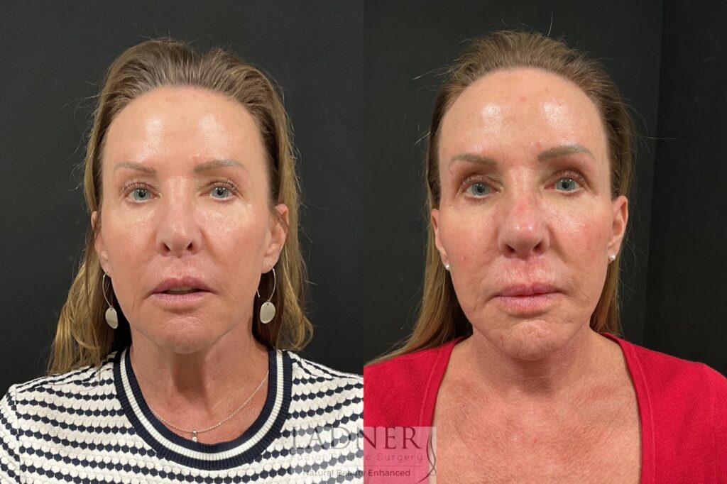 Before and After Image: Deep Plane Lower Facelift, Deep Plane Neck Lift, Fat Transfer to Cheeks - front
