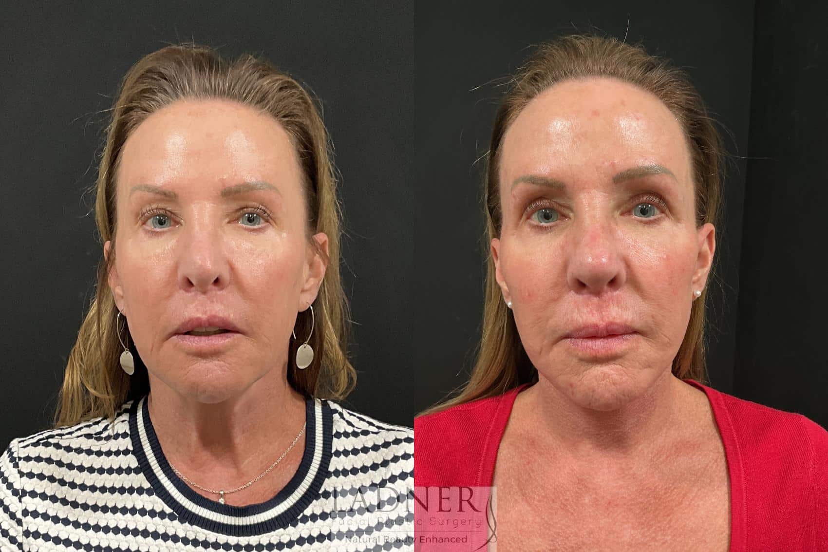 Before and After Image: Deep Plane Lower Facelift, Deep Plane Neck Lift, and Fat Transfer to Cheeks - front