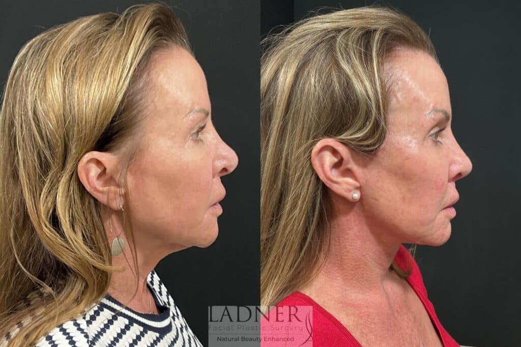 Before and After Image: Deep Plane Lower Facelift, Deep Plane Neck Lift, Fat Transfer to Cheeks - right-side