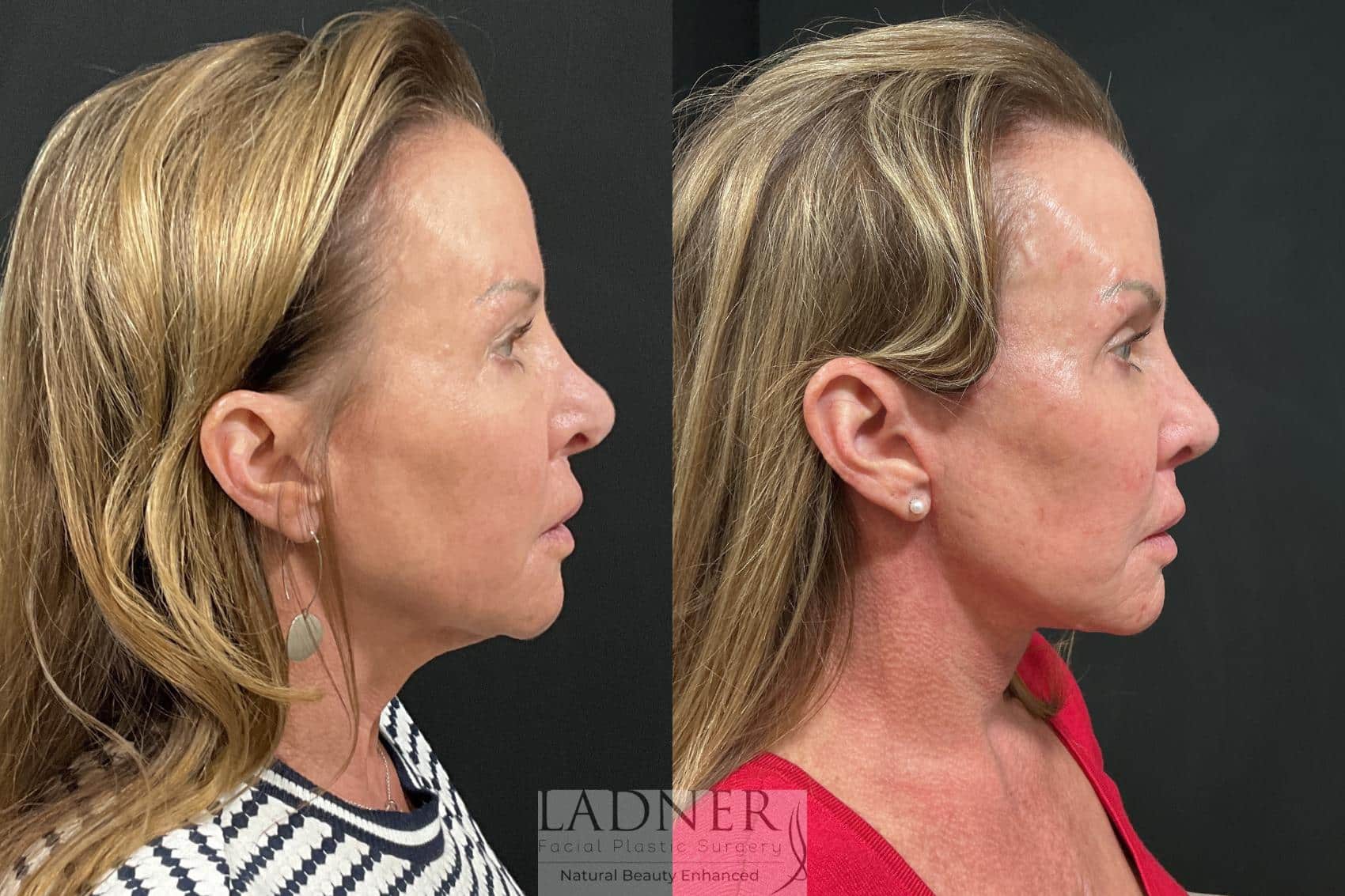 Before and After Image: Deep Plane Lower Facelift, Deep Plane Neck Lift, and Fat Transfer to Cheeks - right-side