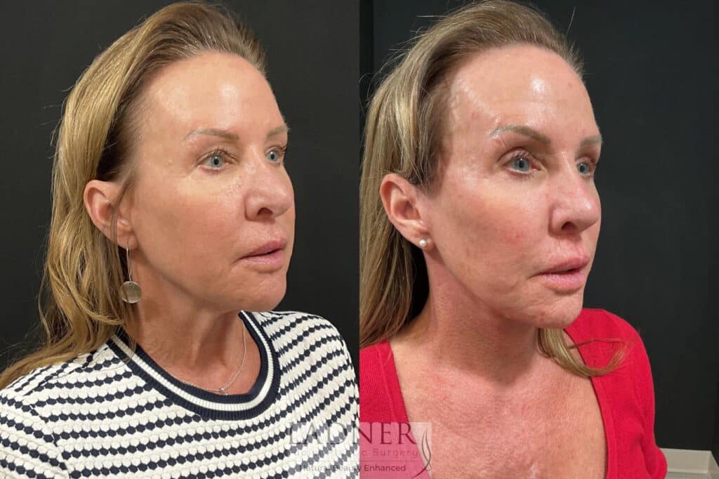Before and After Image: Deep Plane Lower Facelift, Deep Plane Neck Lift, Fat Transfer to Cheeks - right-front-oblique