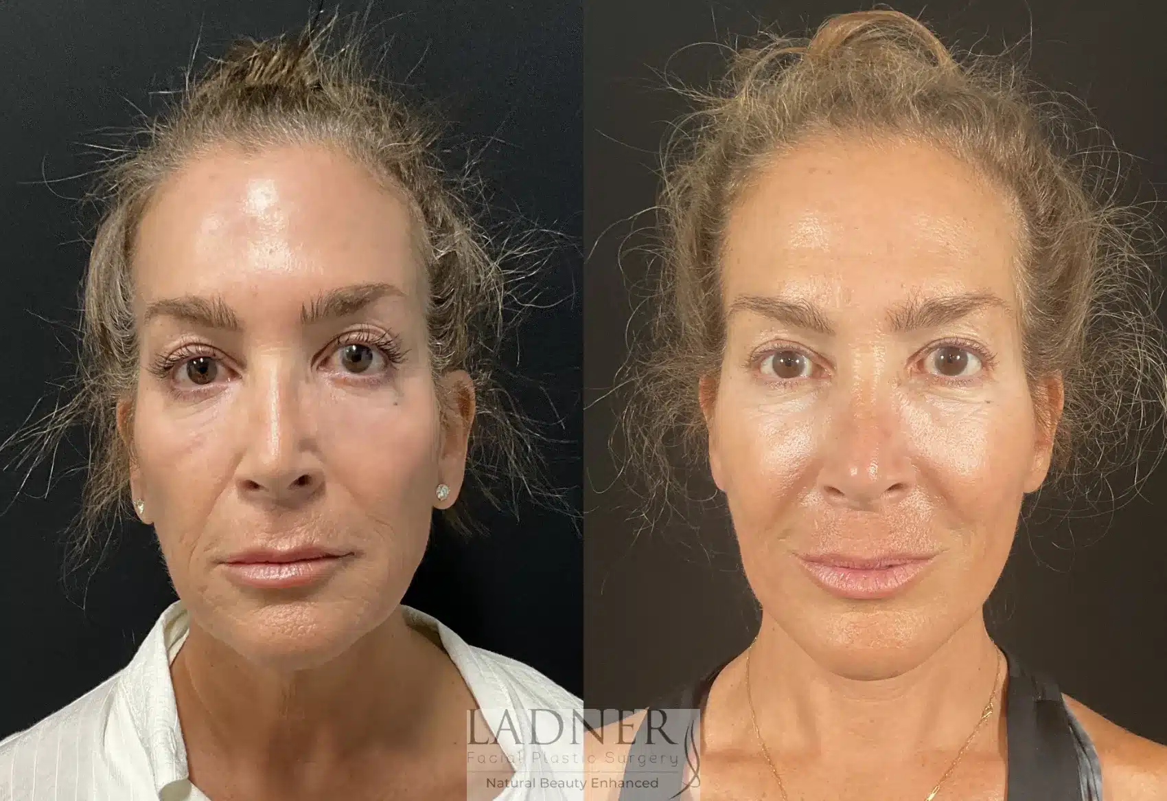 Before and After Image: Deep Plane Facelift - front