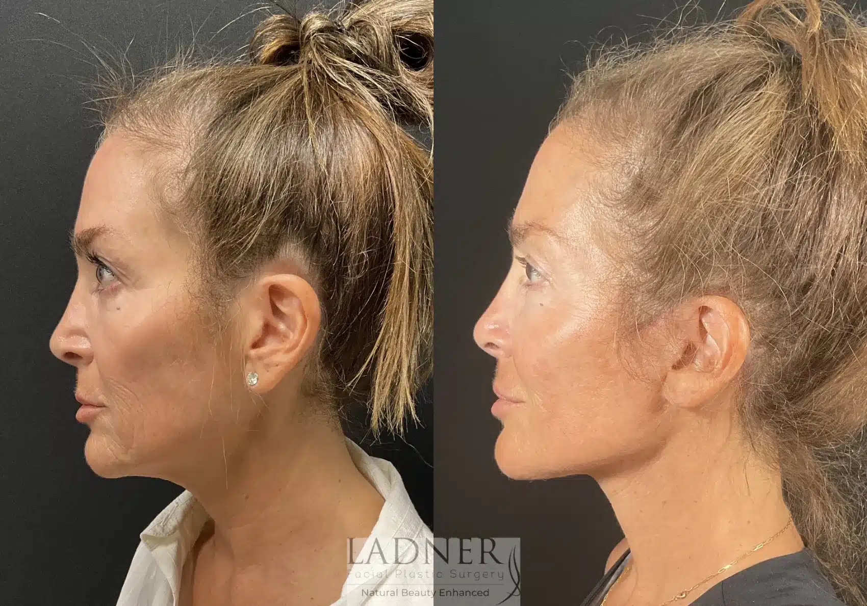 Before and After Image: Deep Plane Facelift - left-side