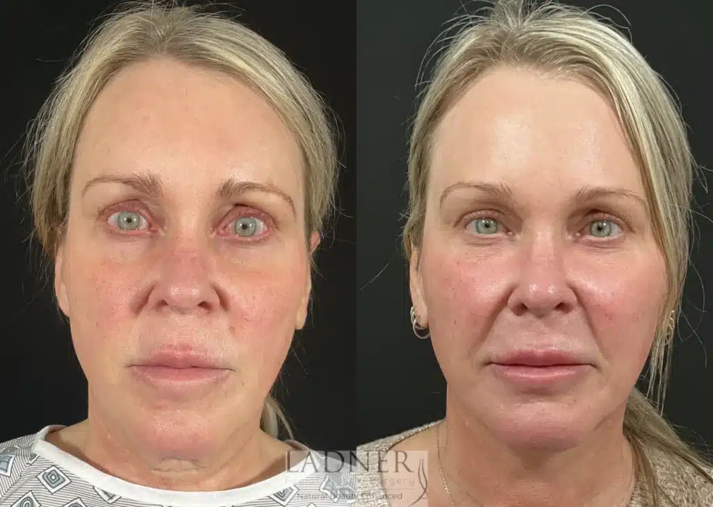 Before and After Image: Submental Liposuction - front
