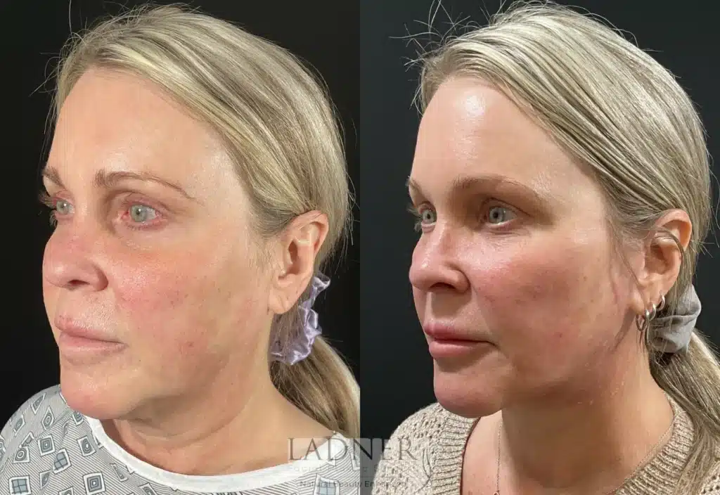 Before and After Image: Submental Liposuction - left-front-oblique