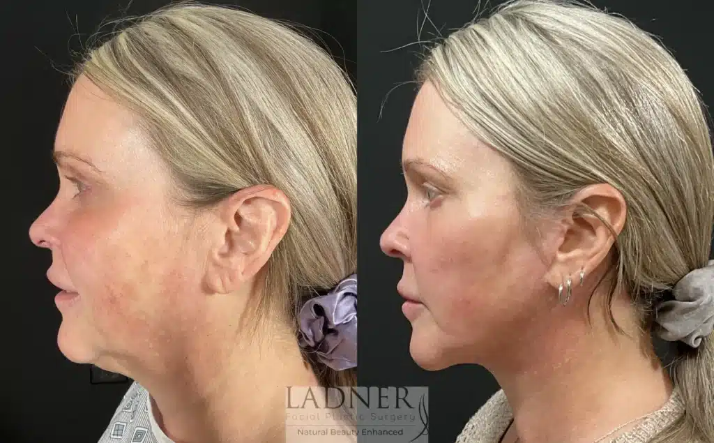 Before and After Image: Submental Liposuction - left-side