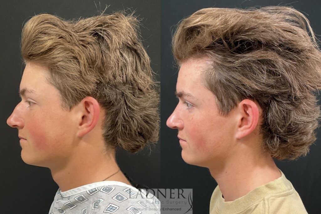Before and After Image: Rhinoplasty - left-side