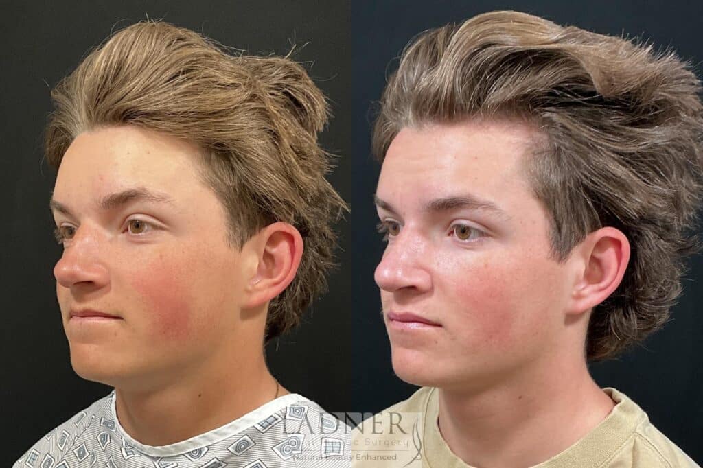 Before and After Image: Rhinoplasty - left-front-oblique