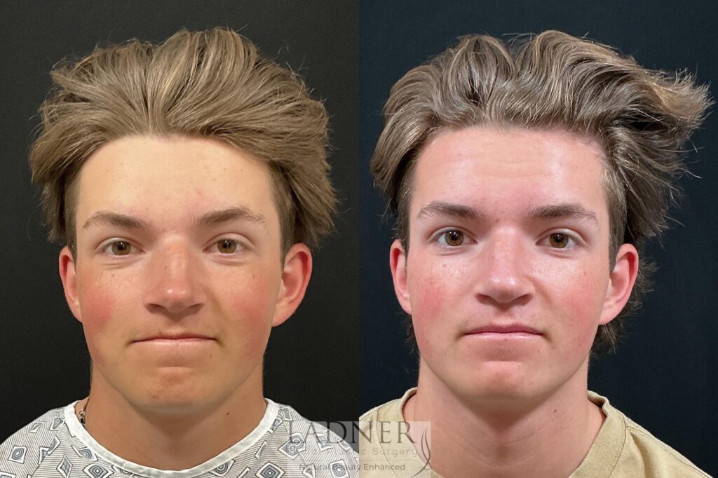 Before and After Image: Rhinoplasty - front