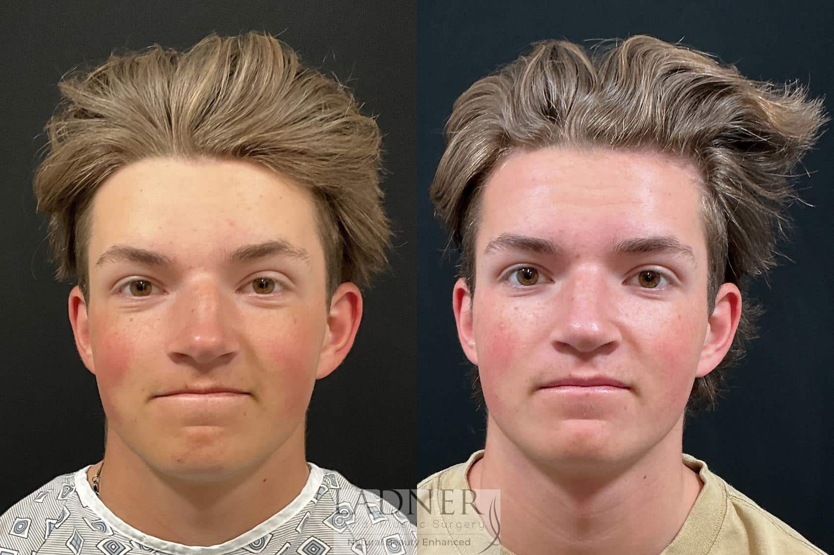 Before and After Image: Open Rhinoplasty - front