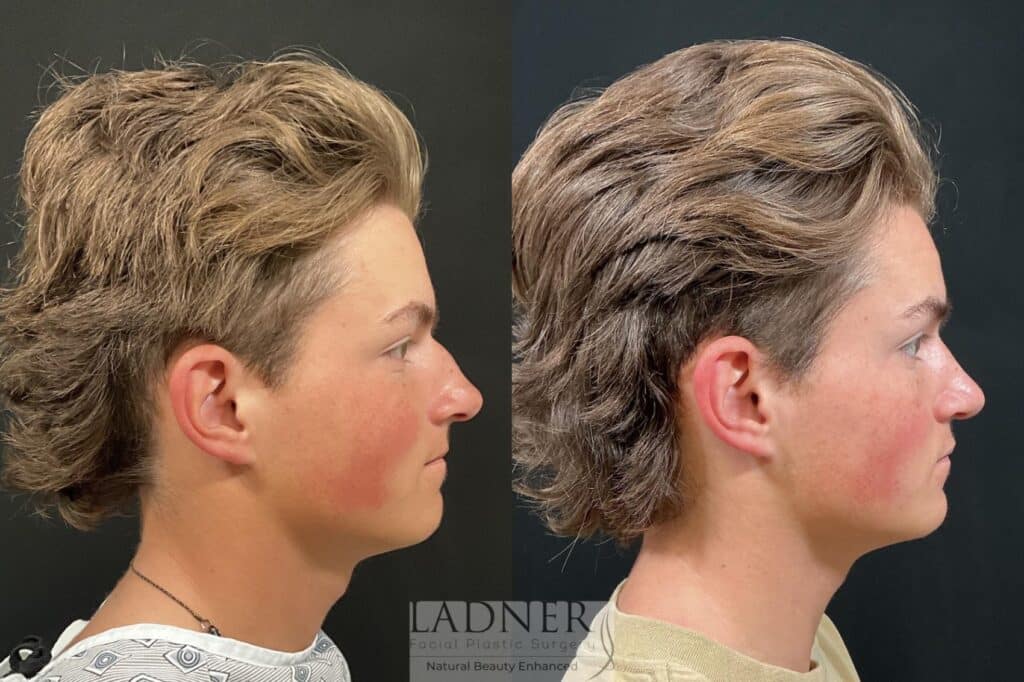 Before and After Image: Rhinoplasty - right-side