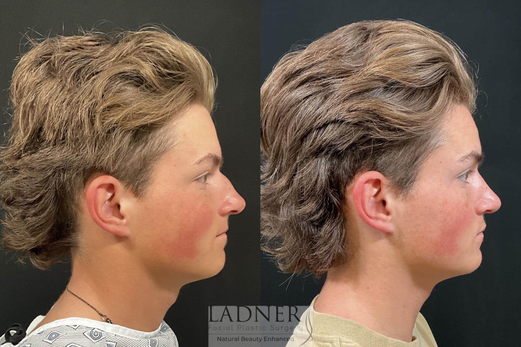 Before and After Image: Open Rhinoplasty - right-side