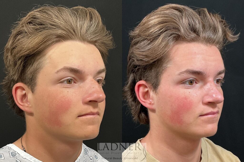 Before and After Image: Rhinoplasty - right-front-oblique