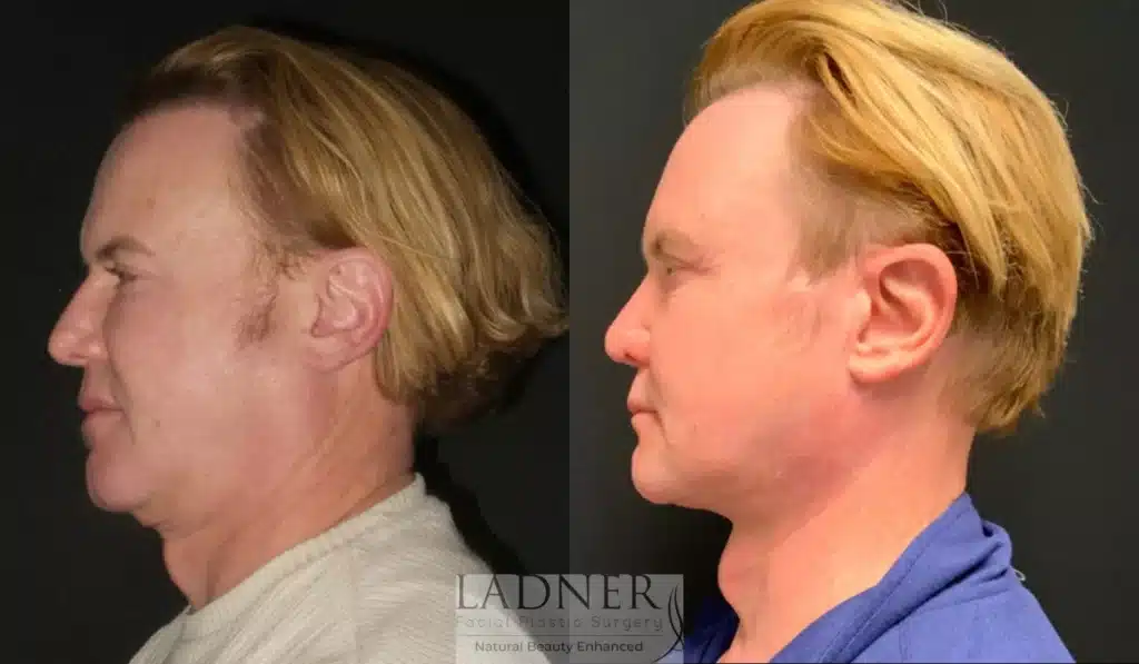 Before and After Image: Facial Plastic Surgery for Men - left-side