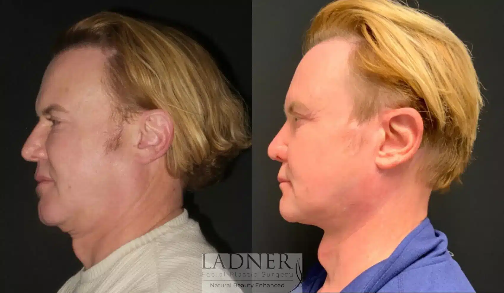 Before and After Image: Deep Plane Facelift - left-side