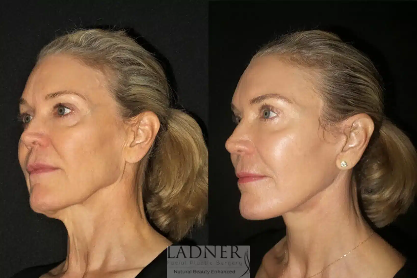 Before and After Image: Deep Plane Facelift/Neck Lift - left-front-oblique