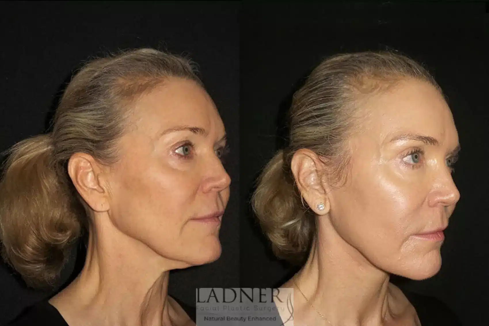 Before and After Image: Blepharoplasty - right-front-oblique