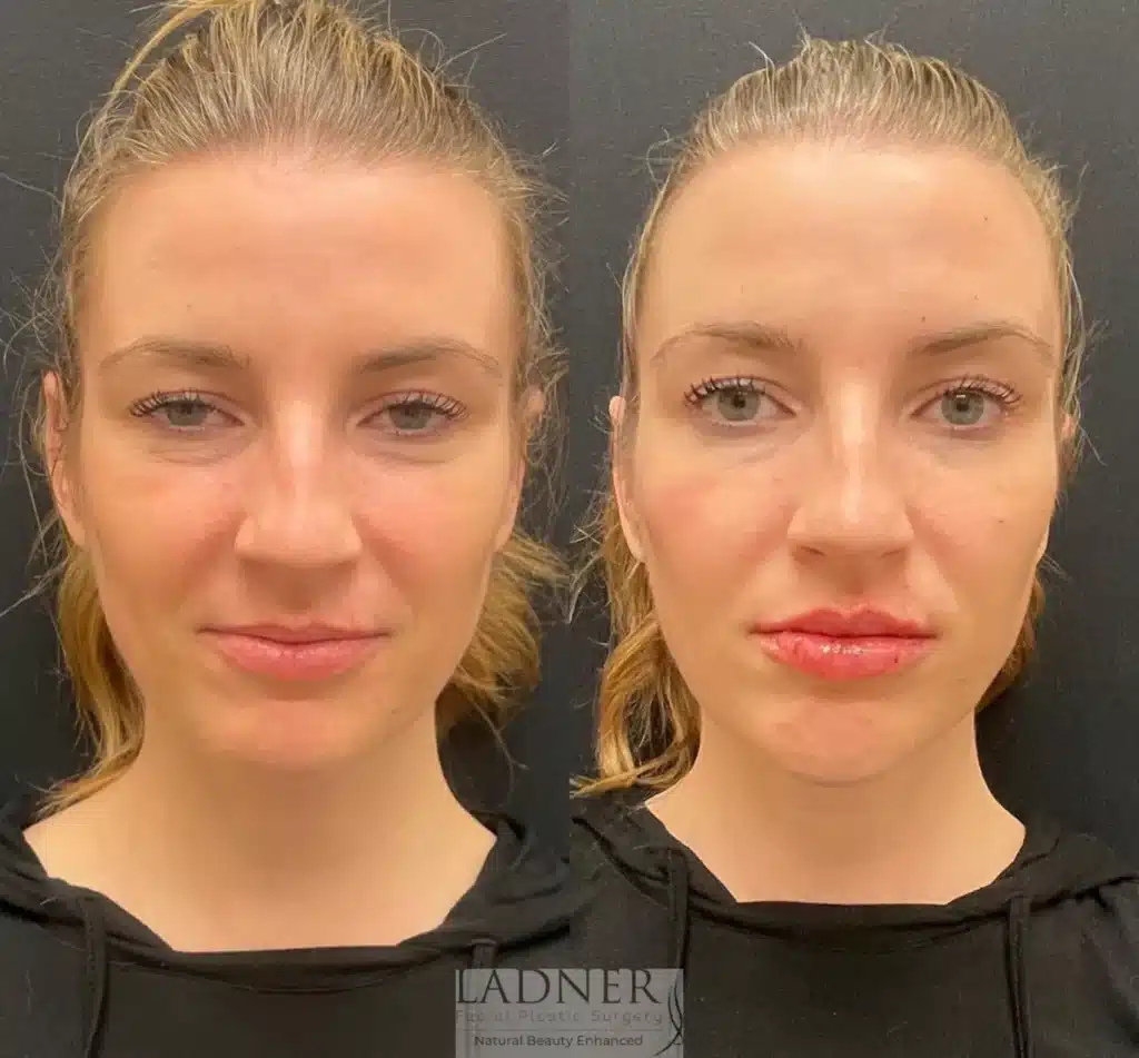 Before and After Image: Lip Fillers - front