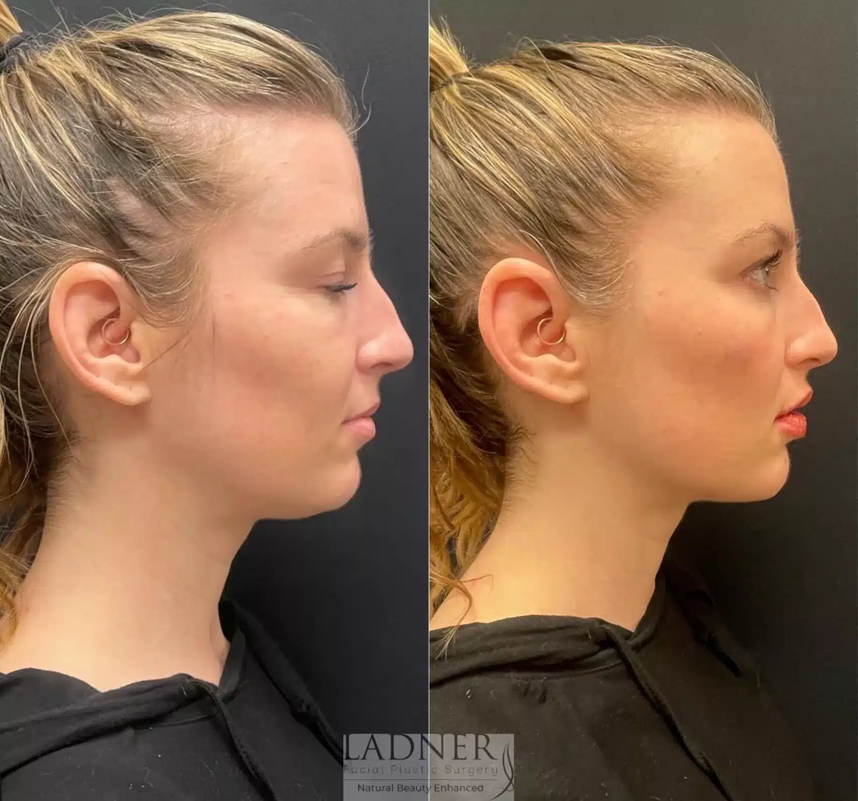 Before and After Image: Lip Fillers - right-side