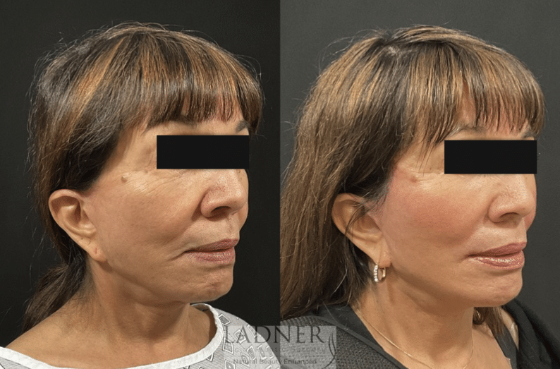 Before and After Image: Deep Plane Facelift, Deep Plane Neck Lift, Corner Lip Lift, and Perioral CO2 Laser Resurfacing - right-front-oblique
