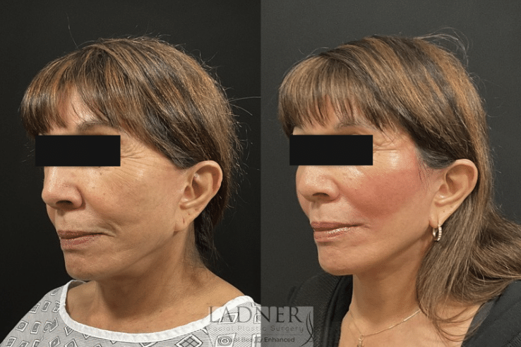 Before and After Image: Deep Plane Facelift, Deep Plane Neck Lift, Corner Lip Lift, and Perioral CO2 Laser Resurfacing - left-front-oblique