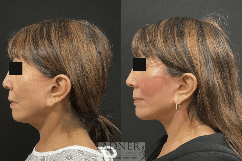 Before and After Image: Deep Plane Facelift, Deep Plane Neck Lift, Corner Lip Lift, and Perioral CO2 Laser Resurfacing - left-side