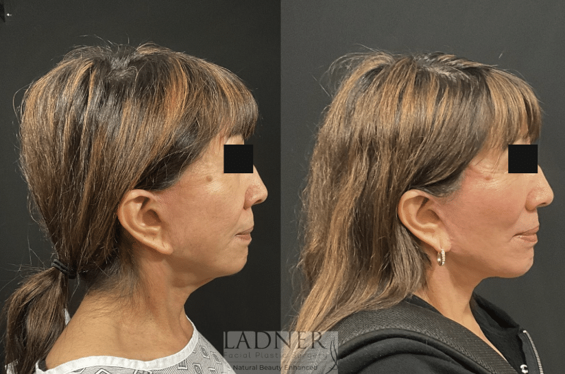 Before and After Image: Deep Plane Facelift, Deep Plane Neck Lift, Corner Lip Lift, and Perioral CO2 Laser Resurfacing - right-side