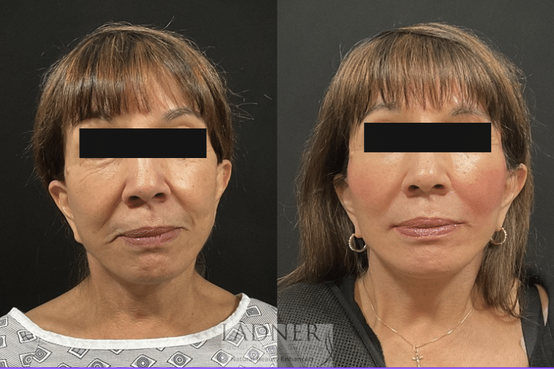 Before and After Image: Deep Plane Facelift, Deep Plane Neck Lift, Corner Lip Lift, and Perioral CO2 Laser Resurfacing - front