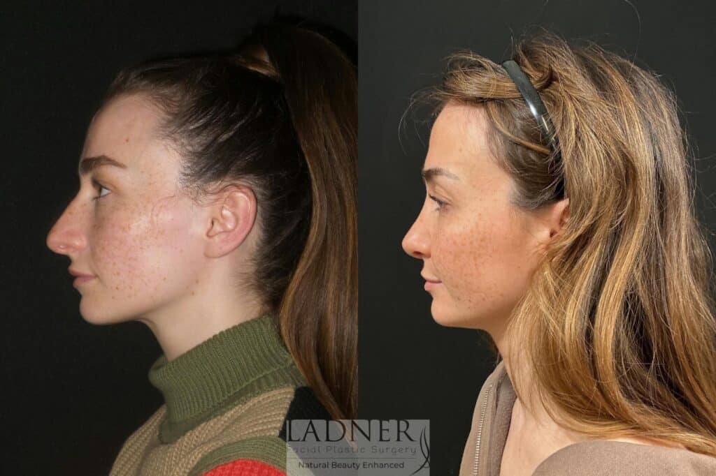 Before and After Image: Rhinoplasty - left-side