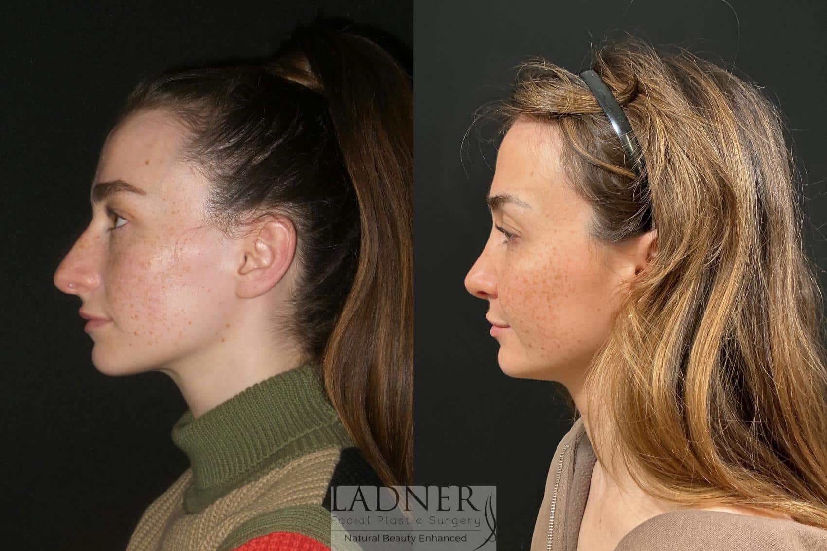 Before and After Image: Open Rhinoplasty - left-side