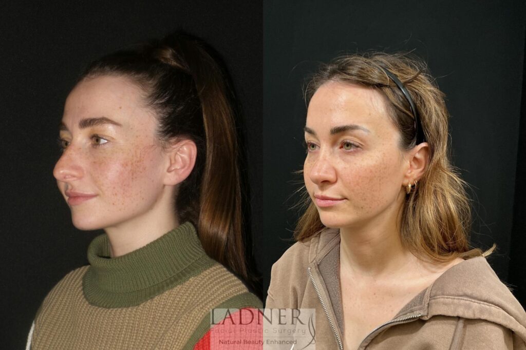 Before and After Image: Rhinoplasty - left-front-oblique