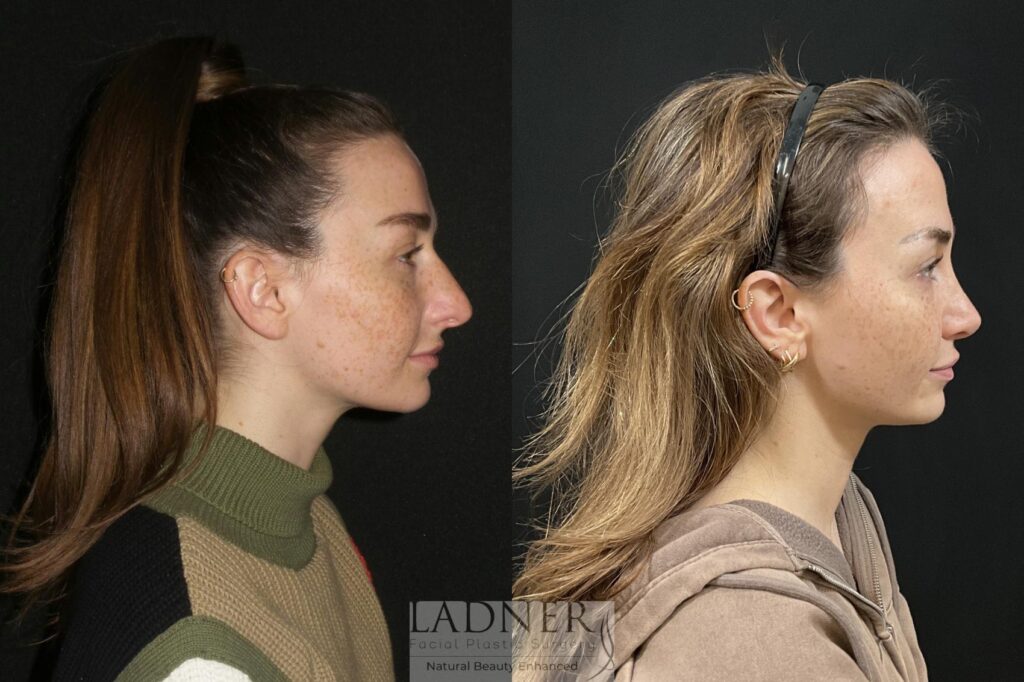 Before and After Image: Rhinoplasty - right-side