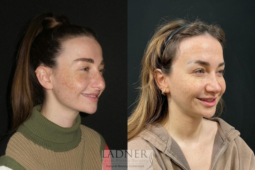Before and After Image: Rhinoplasty - right-front-oblique