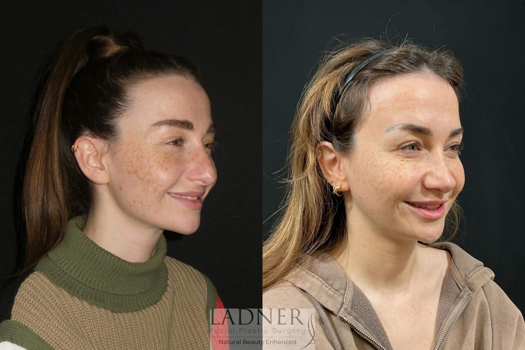 Before and After Image: Open Rhinoplasty - right-front-oblique