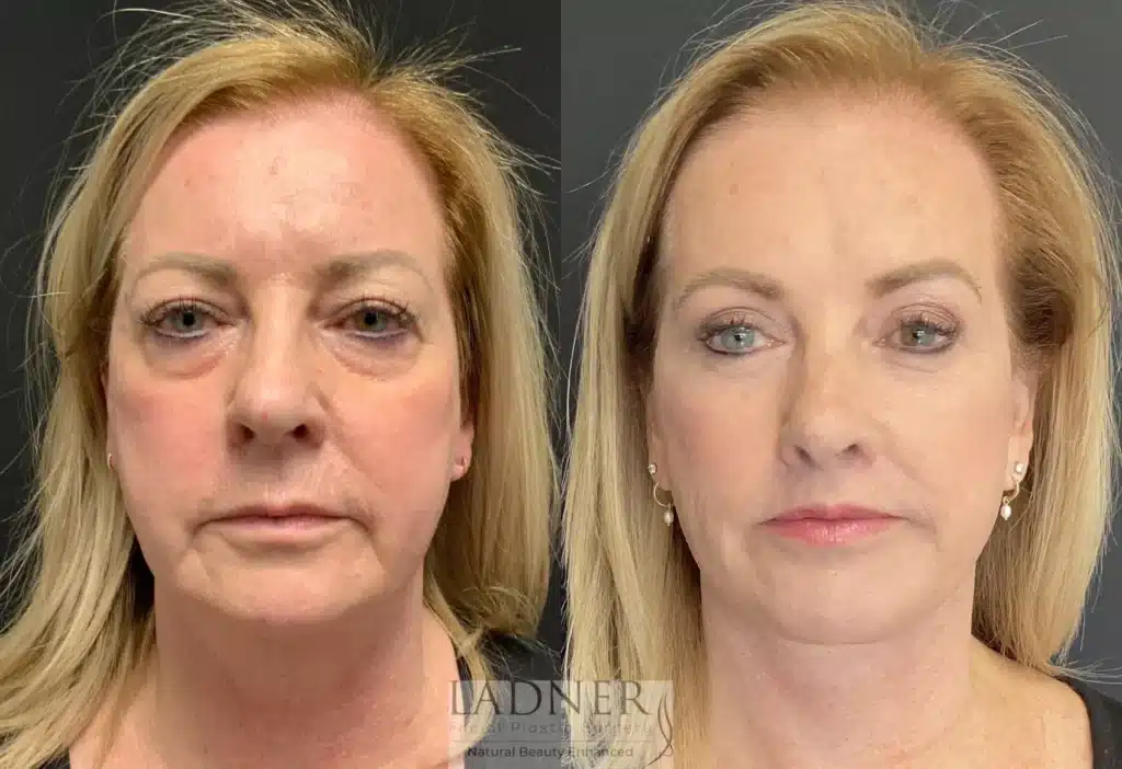 Before and After Image: Deep Plane Facelift/Neck Lift - front