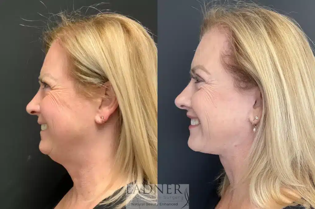 Before and After Image: Deep Plane Facelift/Neck Lift - left-side