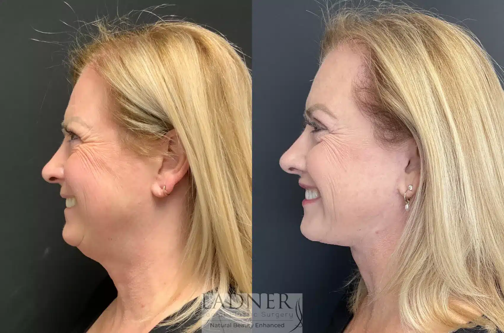 Before and After Image: Blepharoplasty - left-side