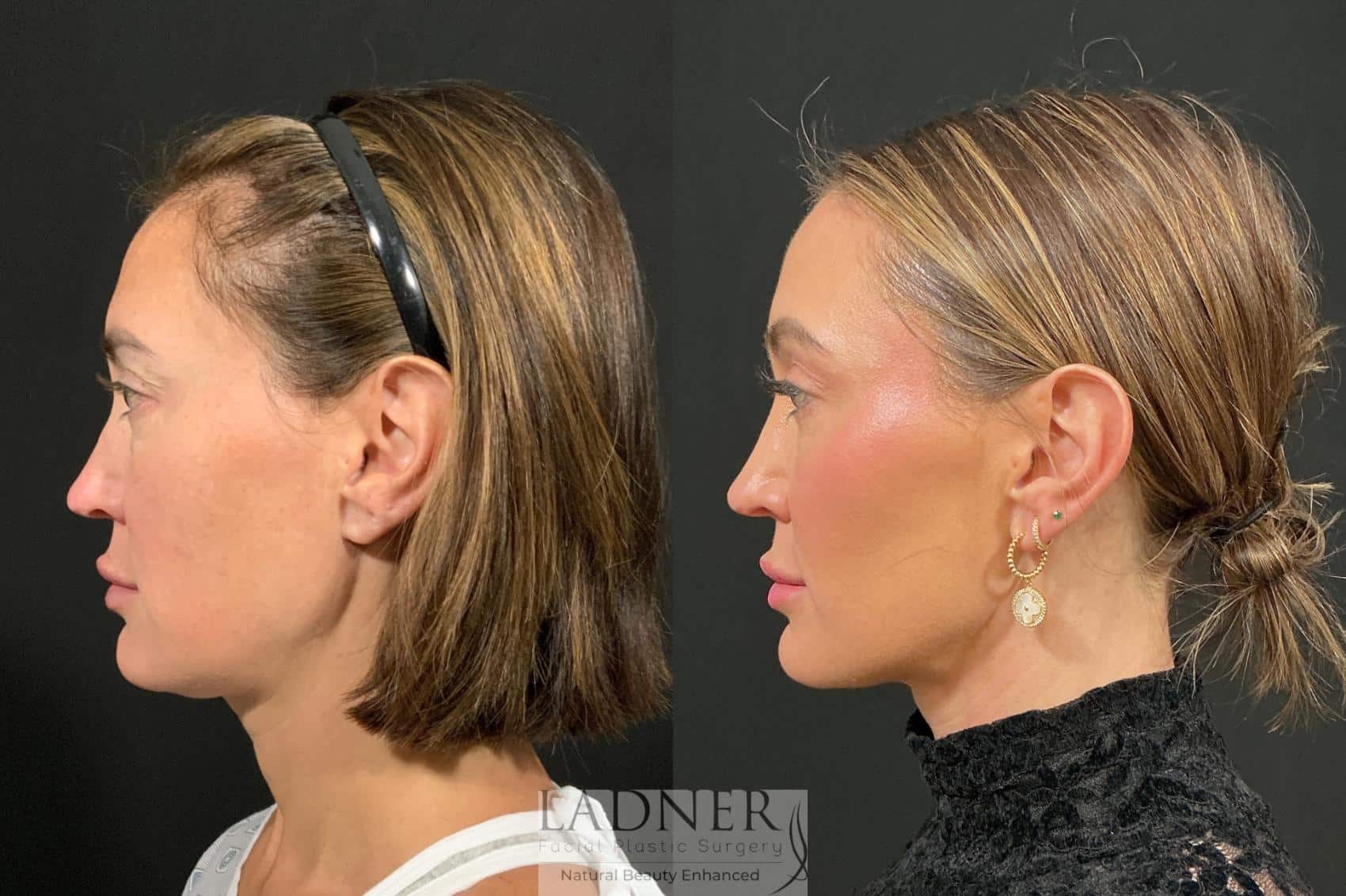 Before and After Image: Browlift - left-side