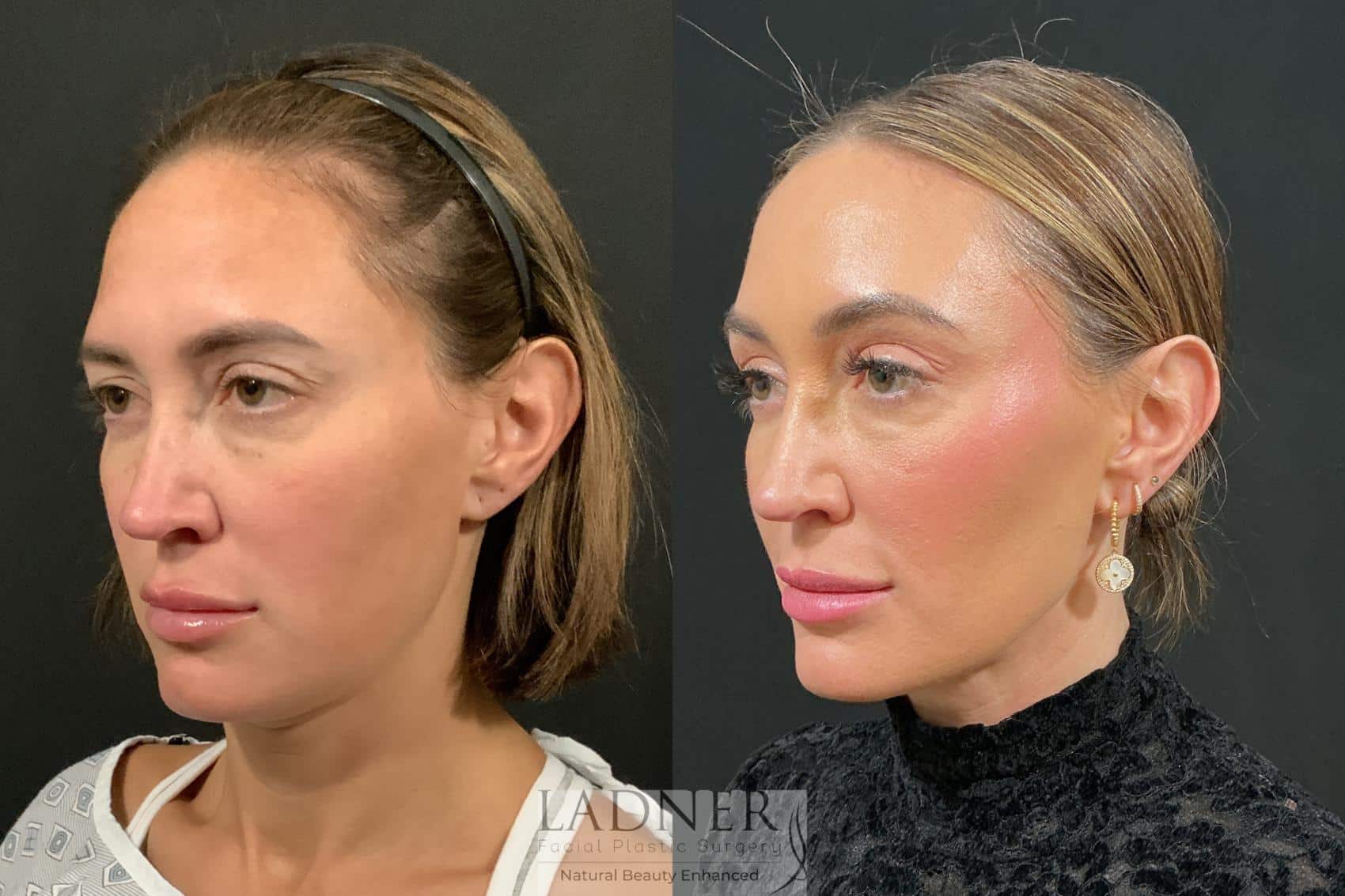 Before and After Image: Browlift - left-front-oblique