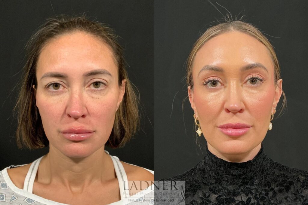 Before and After Image: Browlift - front