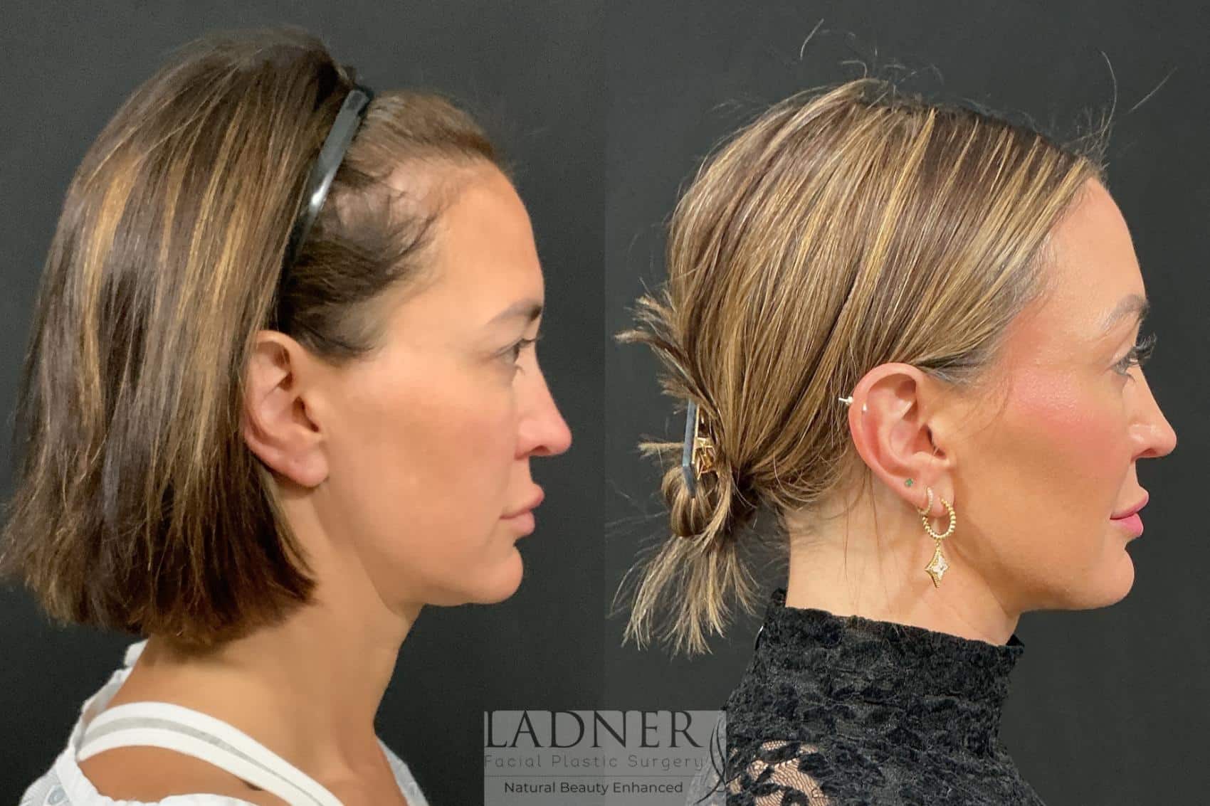 Before and After Image: Browlift - right-side