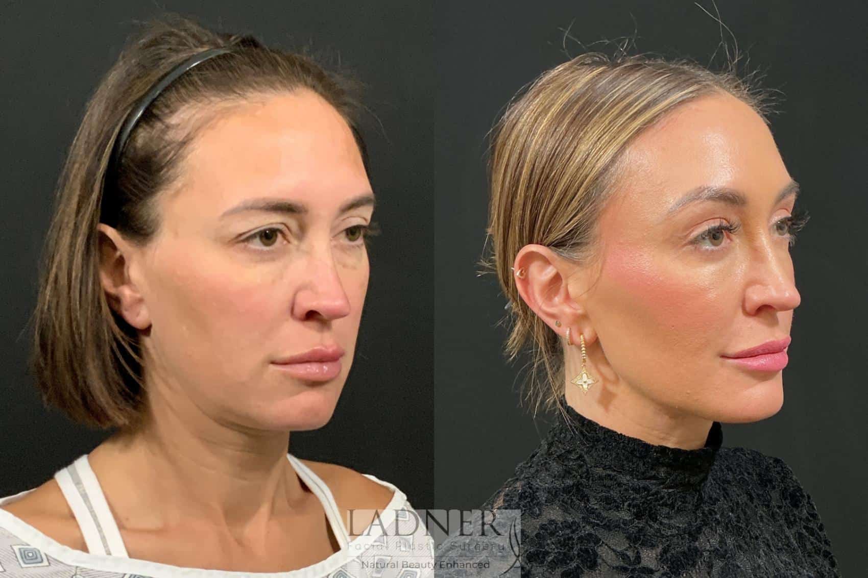 Before and After Image: Browlift - right-front-oblique