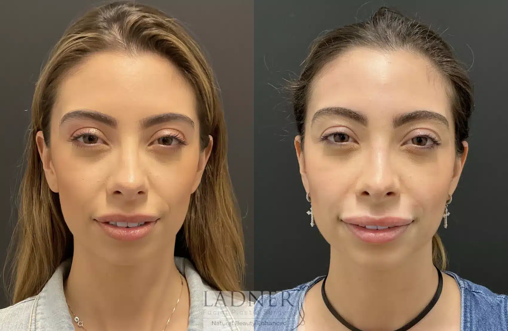 Before and After Image: Rhinoplasty - front