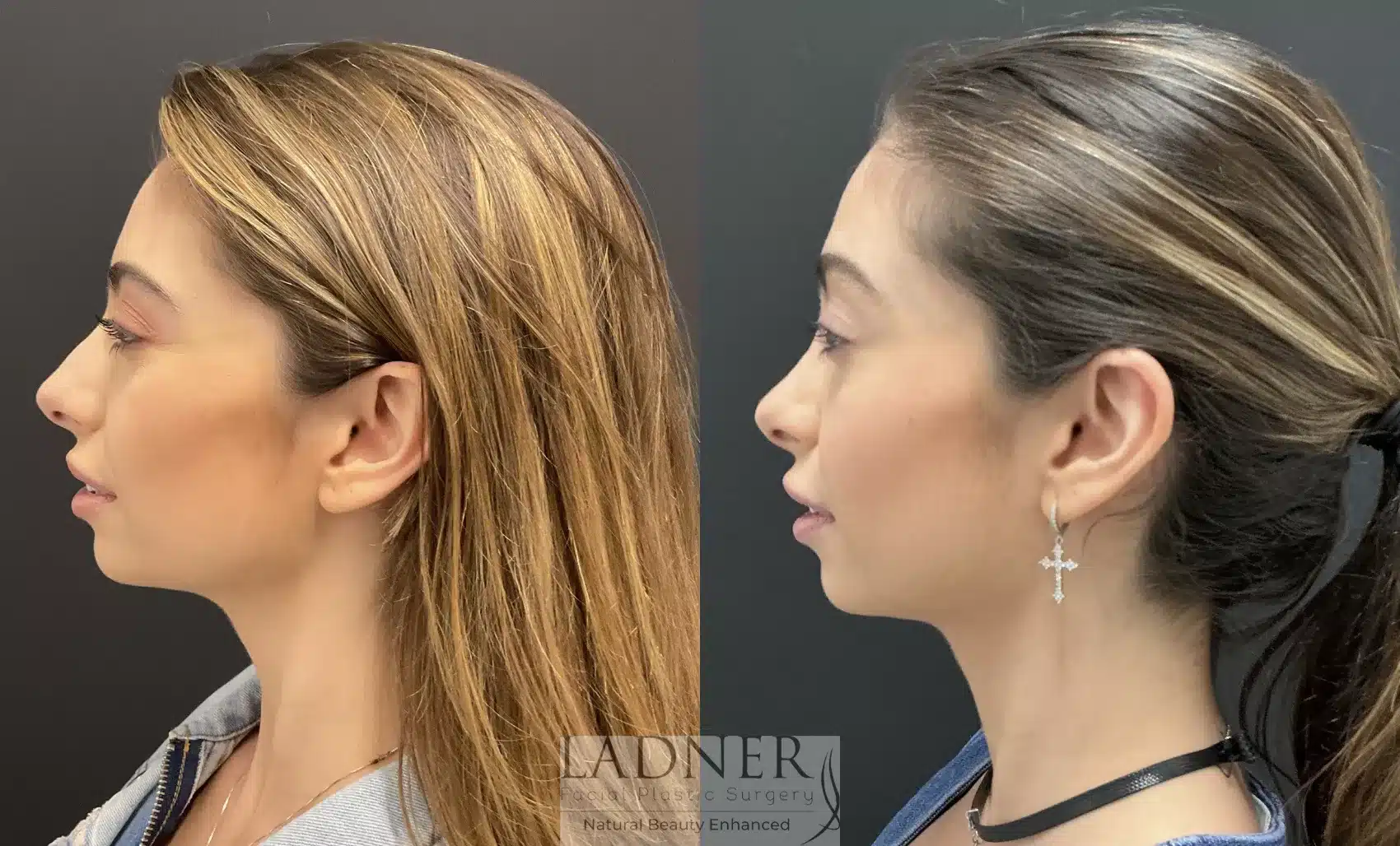 Before and After Image: Rhinoplasty - left-side