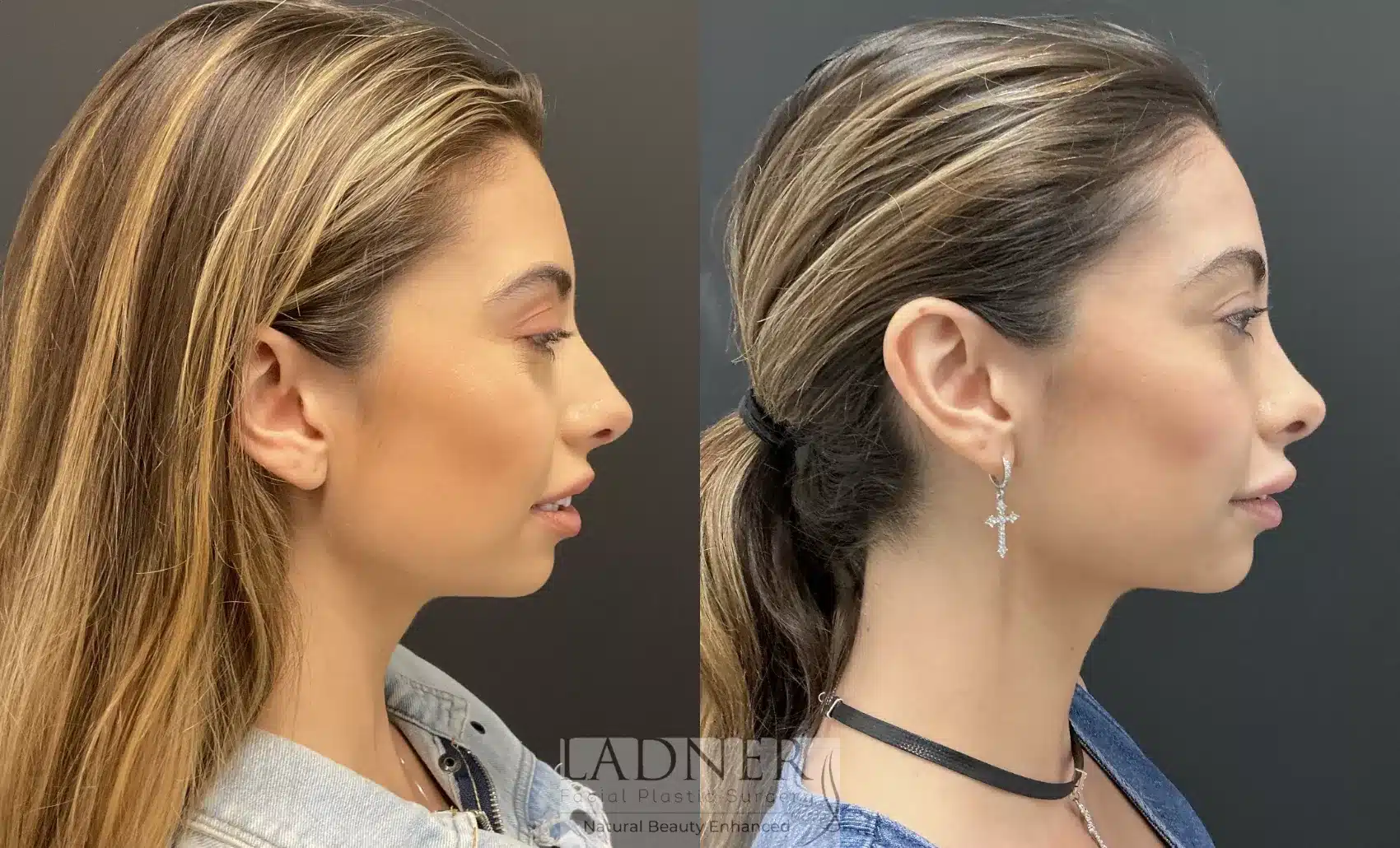 Before and After Image: Rhinoplasty - right-side