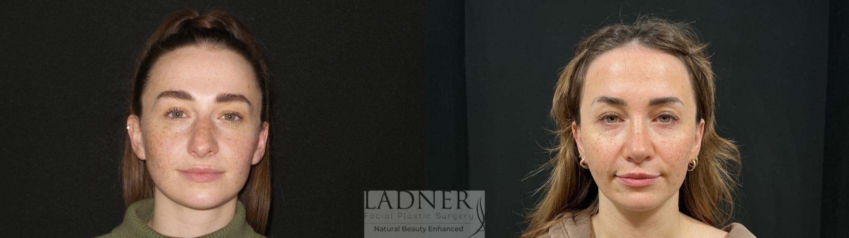 Before and After Image: Open Rhinoplasty - front