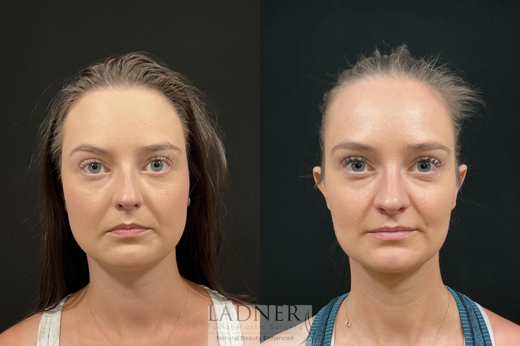 Before and After Image: Rhinoplasty - front