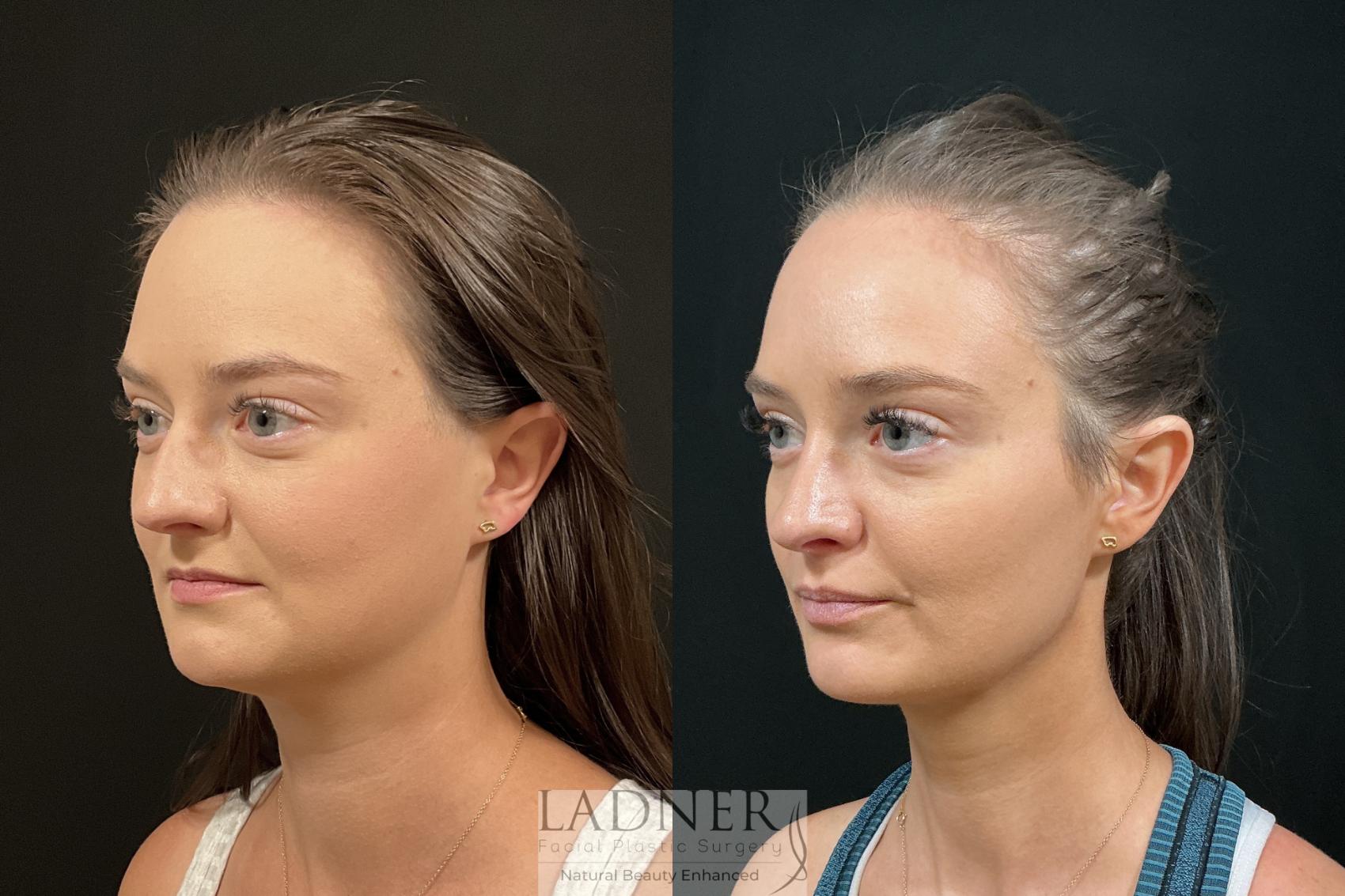 Before and After Image: Rhinoplasty - left-front-oblique
