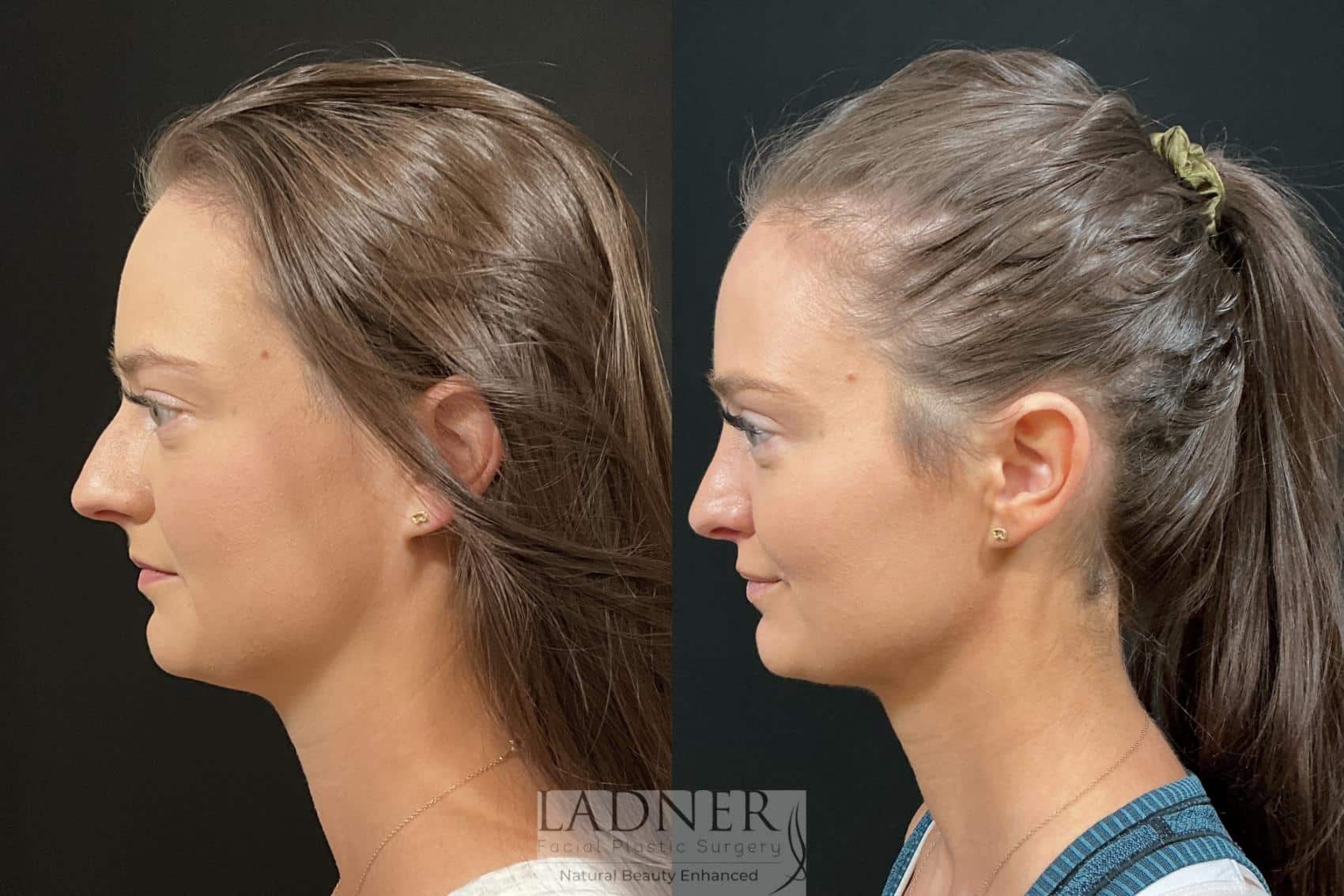 Before and After Image: Rhinoplasty - left-side